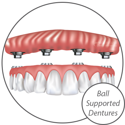 Dr. Peters Offers a Variety of Dental Implant Options