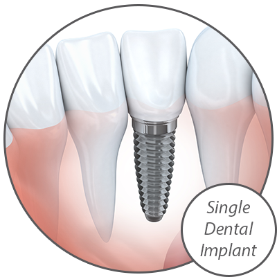 Dr. Peters Offers a Variety of Dental Implant Options